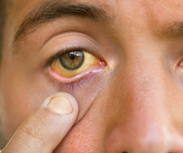 Cirrhosis - What it is, symptoms and treatments 