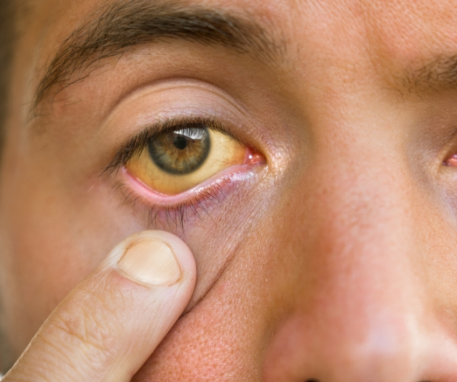 Cirrhose - Qu'est-ce que c'est, symptômes et traitements