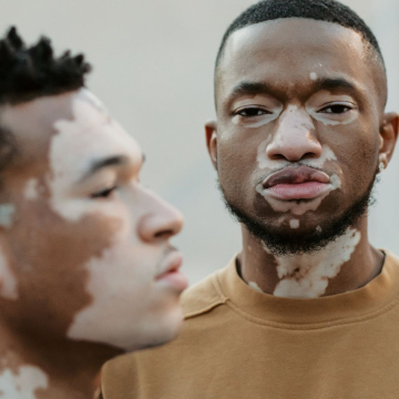 What is Vitiligo? - Types of Vitiligo 